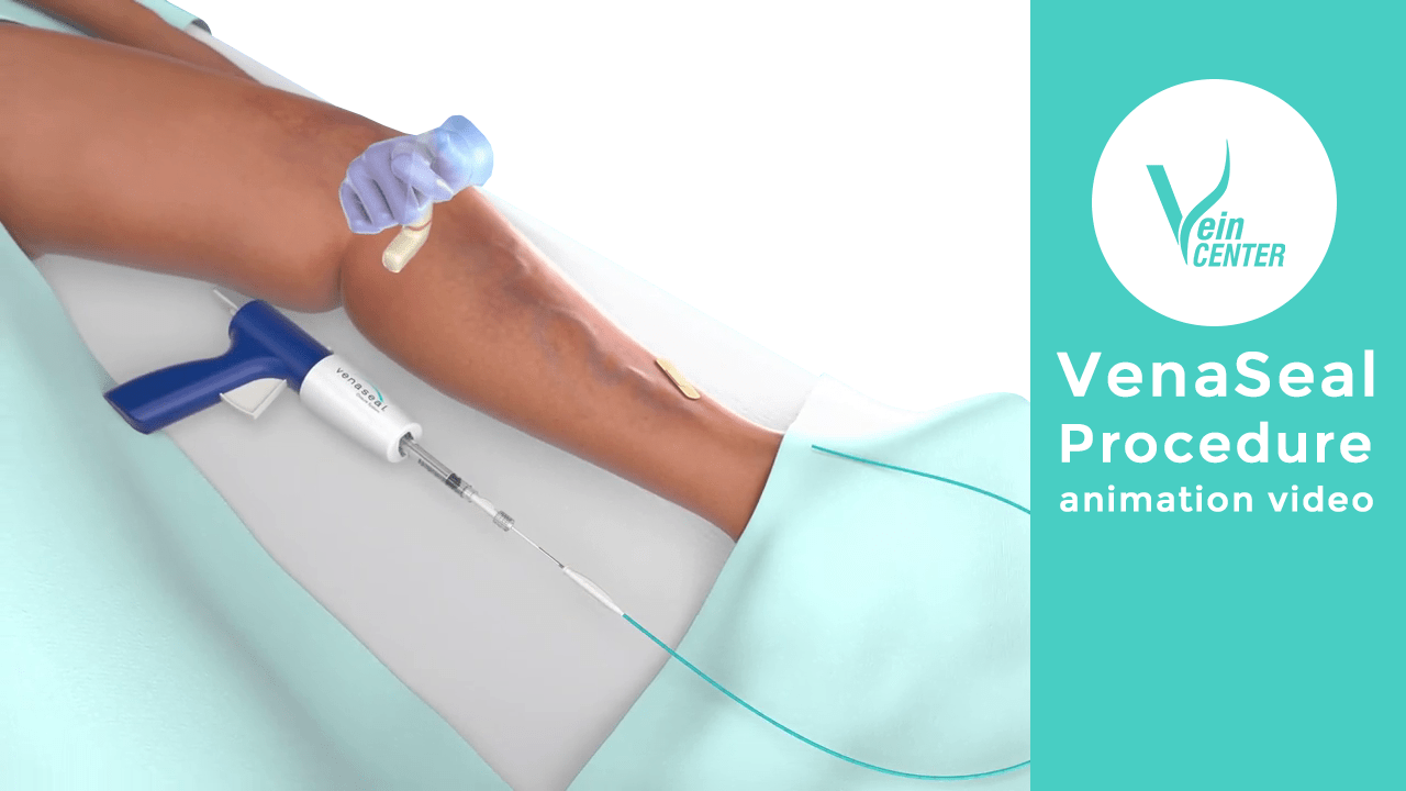 Venaseal And Sclerotherapy Best For Varicose Veins 1 Treatment Vein